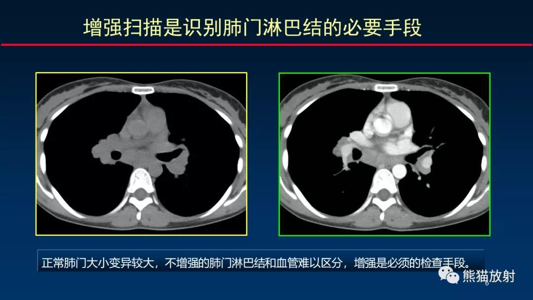 颈部淋巴结最新分区解析，精准医疗的基石与未来方向