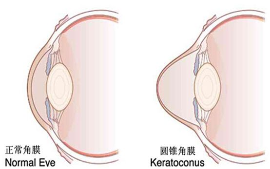 最新的近视眼手术方式